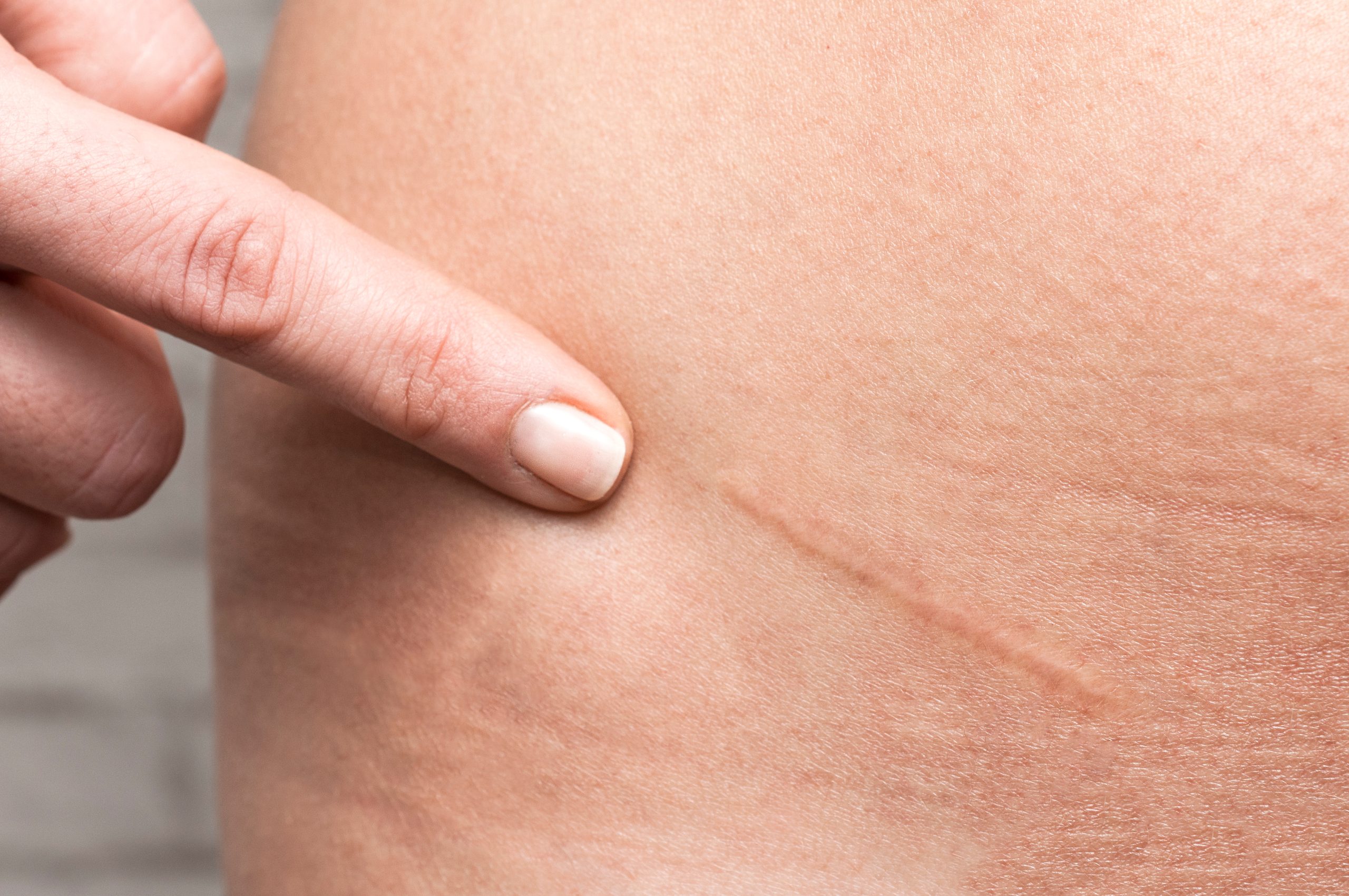 Appendicitis scar on woman's stomach